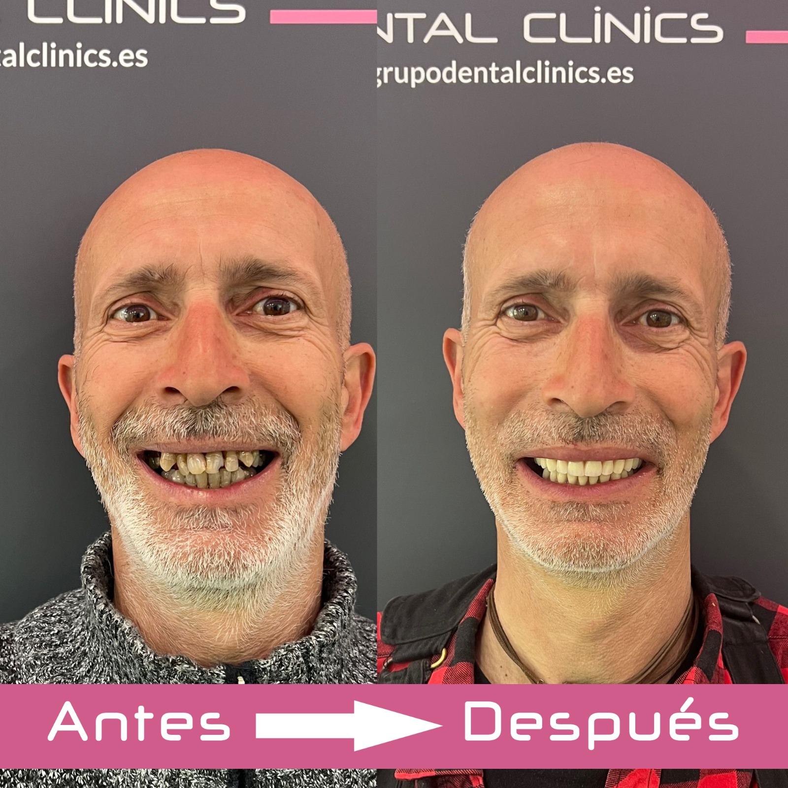 Cómo se pone un diente postizo provisional? - Clínica Dental en Granada